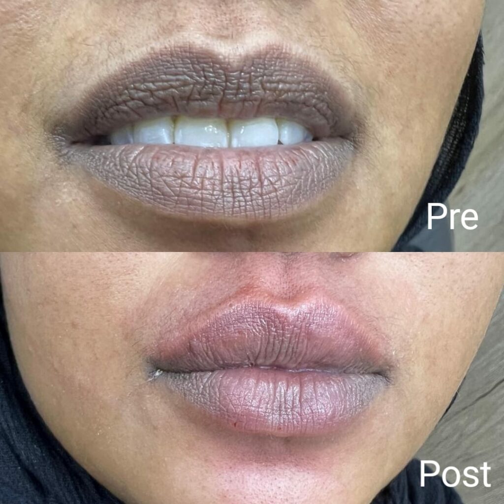 Lip flip results